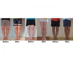 Looking for a Permanent Remedy for Bow Legs - Without the Need for Surgery?