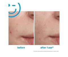 Kate Somerville EradiKate Acne Treatment